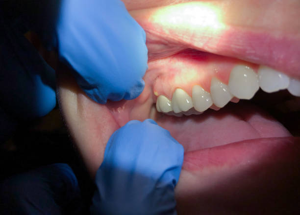 Best Emergency Treatment for Toothache in Petaluma, CA