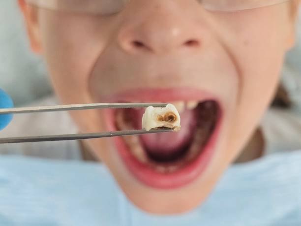 Best Emergency Root Canal Treatment in Petaluma, CA